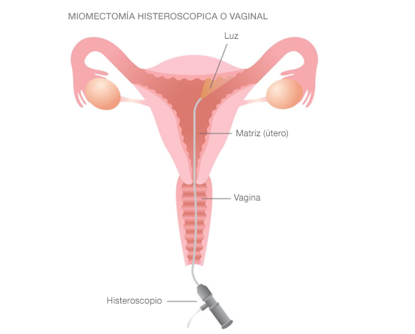 Histeroscópica o miomectomía vaginal