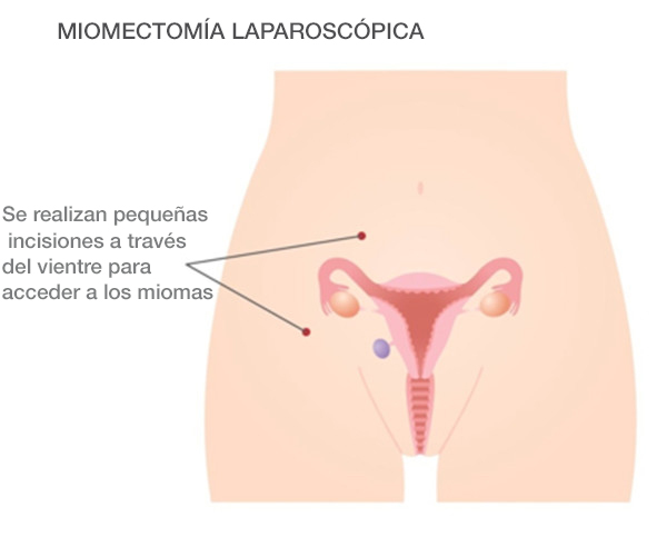 Miomectomía laparoscópica
