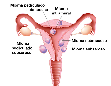 Diferentes tipos de miomas uterinos
